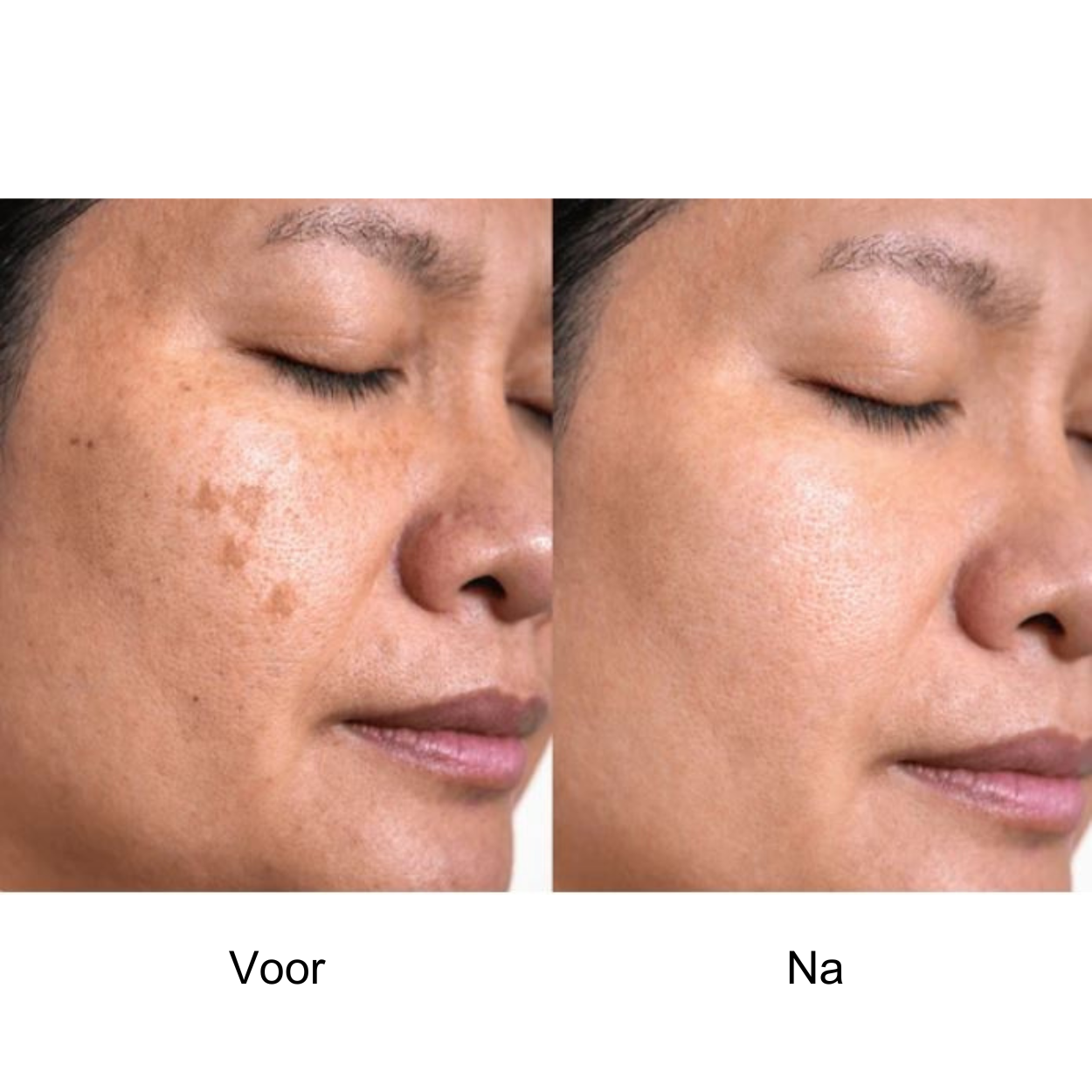 EgaleHuid™ | Pigmentvlekjes Corrigerend Serum